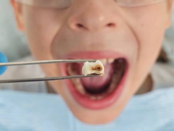 Best Emergency Tooth Extraction in Friona, TX